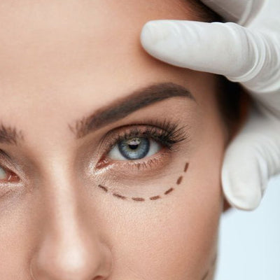 Blefaroplastia Inferior