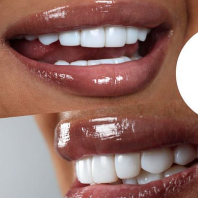 Diseño de sonrisa con carillas 20 dientes