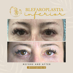 Blefaroplastia Inferior