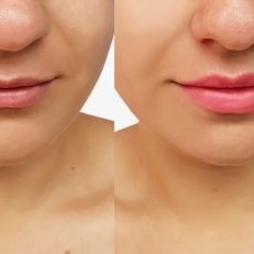 Lifting de labios inferior