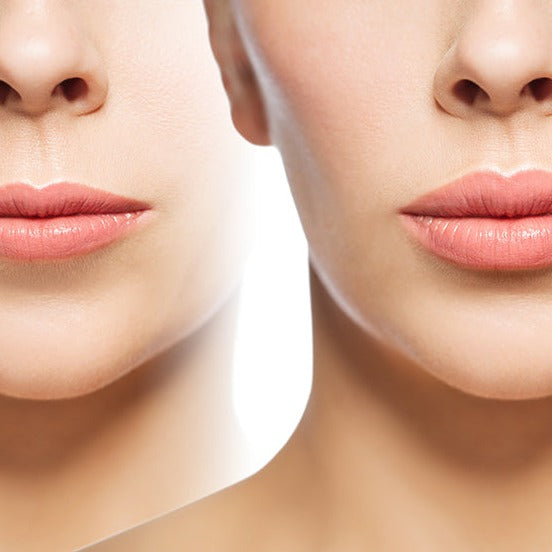 Lifting de labios superior