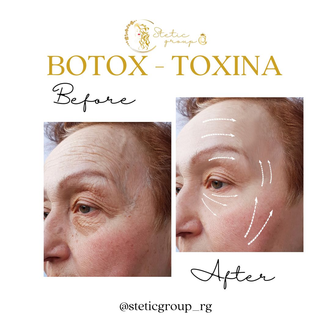 Botox – Stetic Group RG