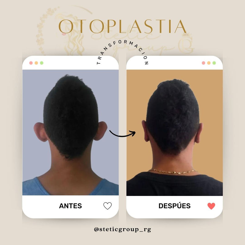 Otoplastia
